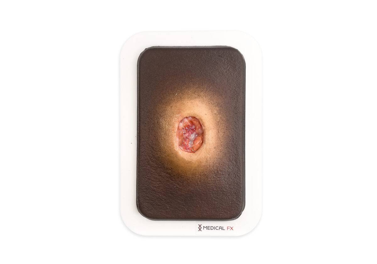 PW10 04 0059 02 4 Pocketwunde Verhornung MEDICAL FX Germany LQ 1