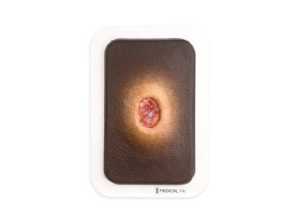 PW10 04 0059 02 4 Pocketwunde Verhornung MEDICAL FX Germany LQ 1
