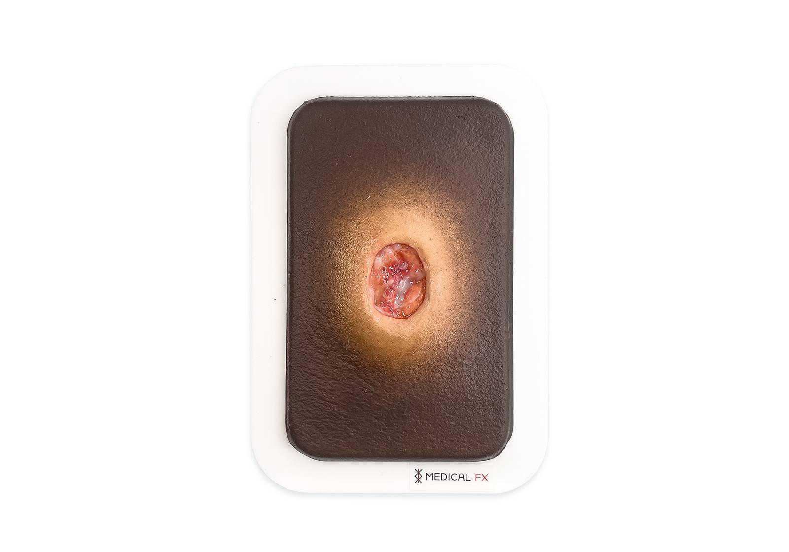 PW10 04 0059 02 4 Pocketwunde Verhornung MEDICAL FX Germany LQ 1