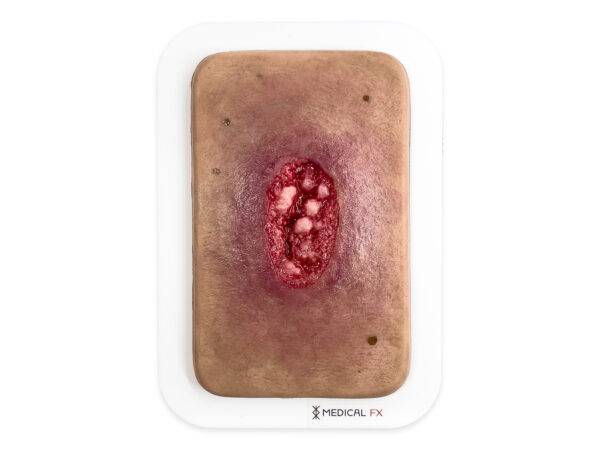 PW10 04 0062 00 3 Pocketwunde Hypergranulation LQ