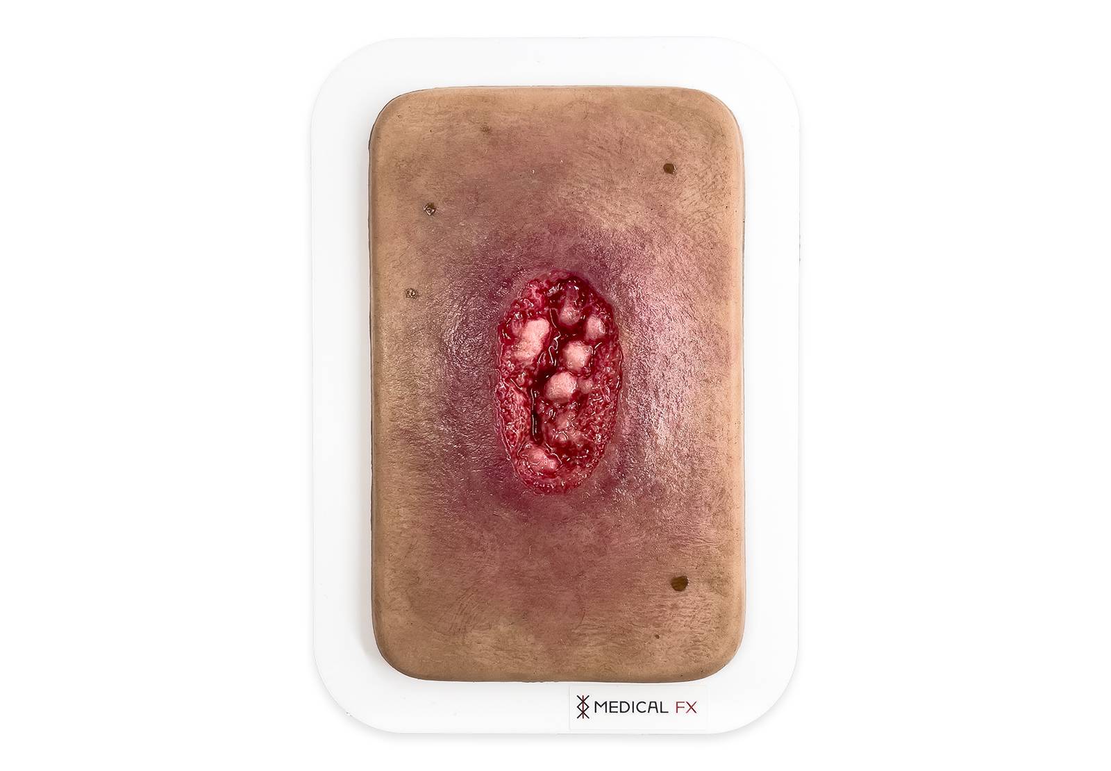 PW10 04 0062 00 3 Pocketwunde Hypergranulation LQ