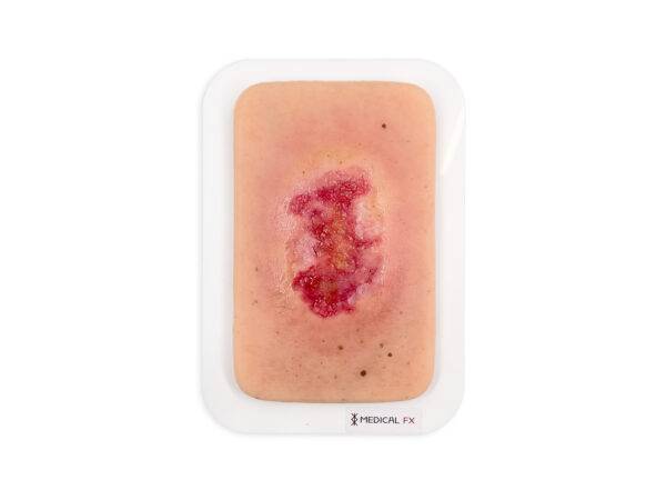 Das „Pocketwunde Epithelisierung“-Wundmodell von MEDICAL FX Germany präsentiert sich im praktischen Smartphone-Format und ermöglicht die Darstellung des Epithelisierungsprozesses…