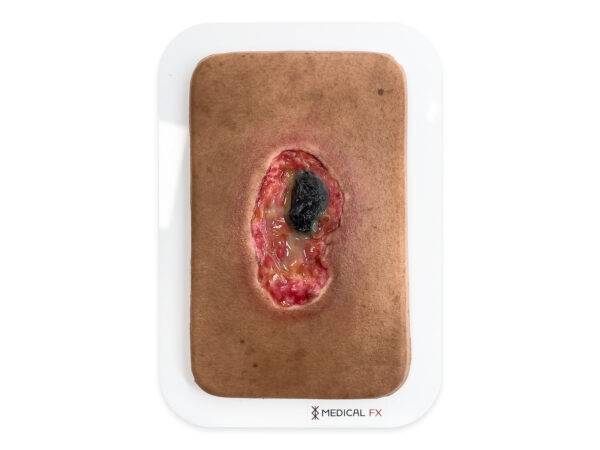 PW10 04 0064 00 3Pocketwunde Nekrose Farbe 3 LQ