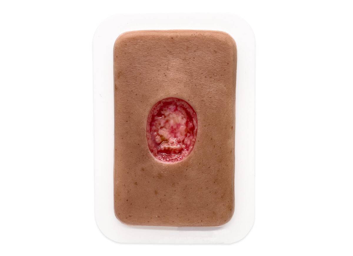 Pocketwunde Chirurgische Wunde MOHS medicalfx silikonmodell silikonwunde