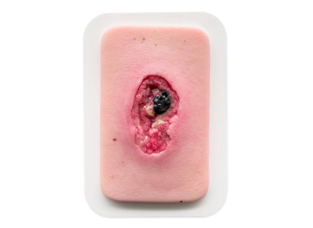 Das Wundmodell „Pocketwunde Nekrose“ von MEDICAL FX Germany überzeugt durch seine außergewöhnliche Detailgenauigkeit und vermittelt eine realistische Darstellung nekrotischen Gewe…