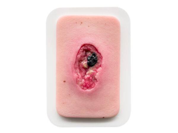 Das Wundmodell „Pocketwunde Nekrose“ von MEDICAL FX Germany überzeugt durch seine außergewöhnliche Detailgenauigkeit und vermittelt eine realistische Darstellung nekrotischen Gewe…