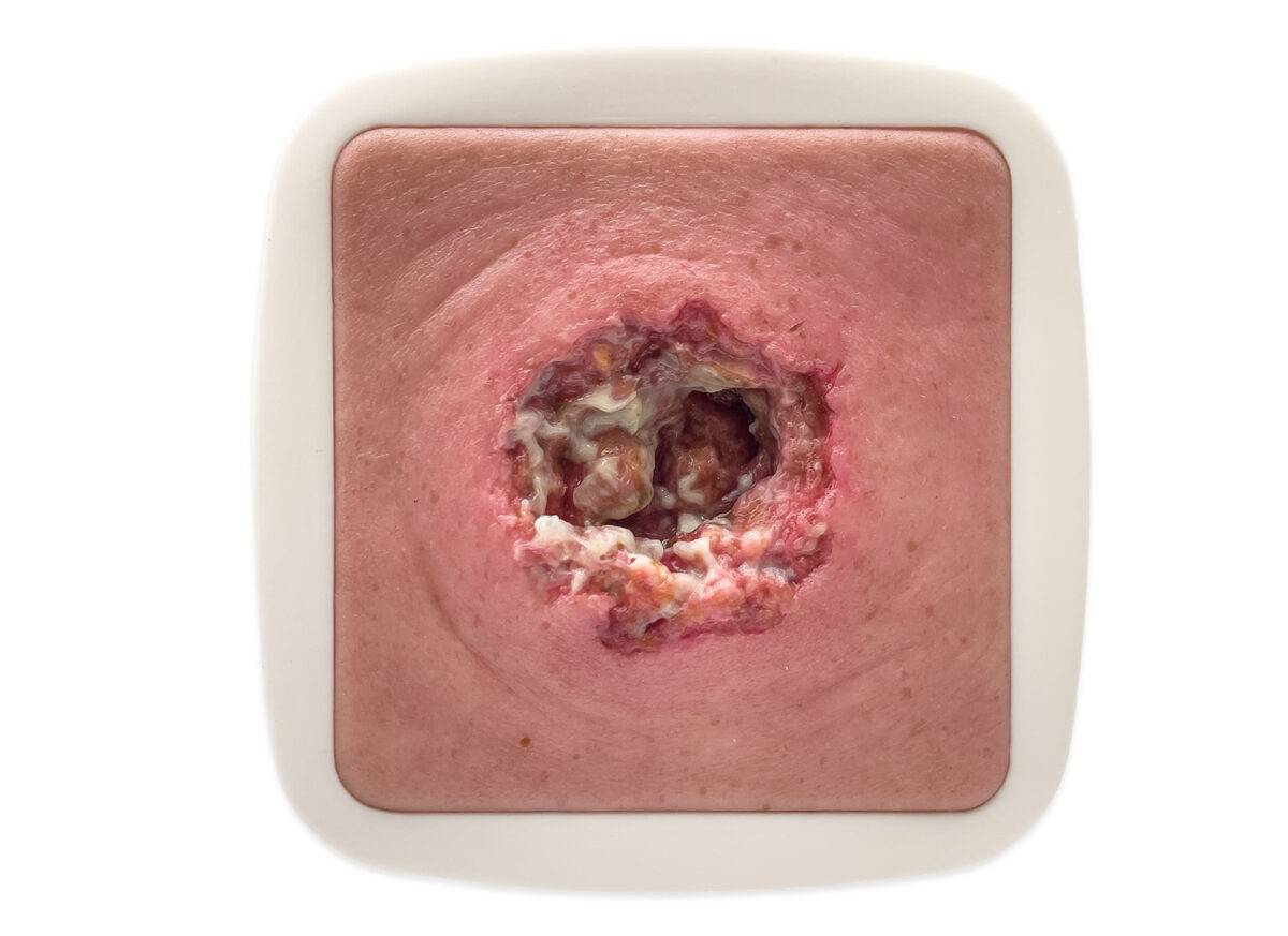 Das Modell „Rahmenmodell Dekubitus mit zerklüftetem Wundrand“ von MEDICAL FX Germany zeichnet sich durch seine präzise Darstellung eines Dekubitus mit stark zerklüfteten Wundrände…