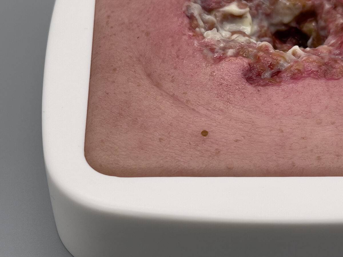 Das Modell „Rahmenmodell Dekubitus mit zerklüftetem Wundrand“ von MEDICAL FX Germany zeichnet sich durch seine präzise Darstellung eines Dekubitus mit stark zerklüfteten Wundrände…