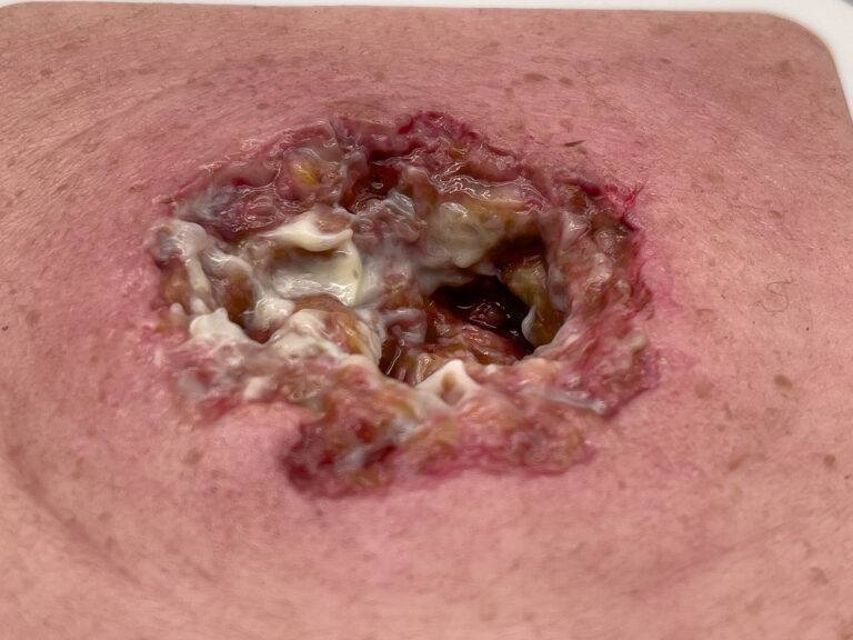 Das Modell „Rahmenmodell Dekubitus mit zerklüftetem Wundrand“ von MEDICAL FX Germany zeichnet sich durch seine präzise Darstellung eines Dekubitus mit stark zerklüfteten Wundrände…