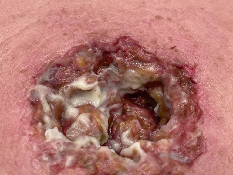 Das Modell „Rahmenmodell Dekubitus mit zerklüftetem Wundrand“ von MEDICAL FX Germany zeichnet sich durch seine präzise Darstellung eines Dekubitus mit stark zerklüfteten Wundrände…