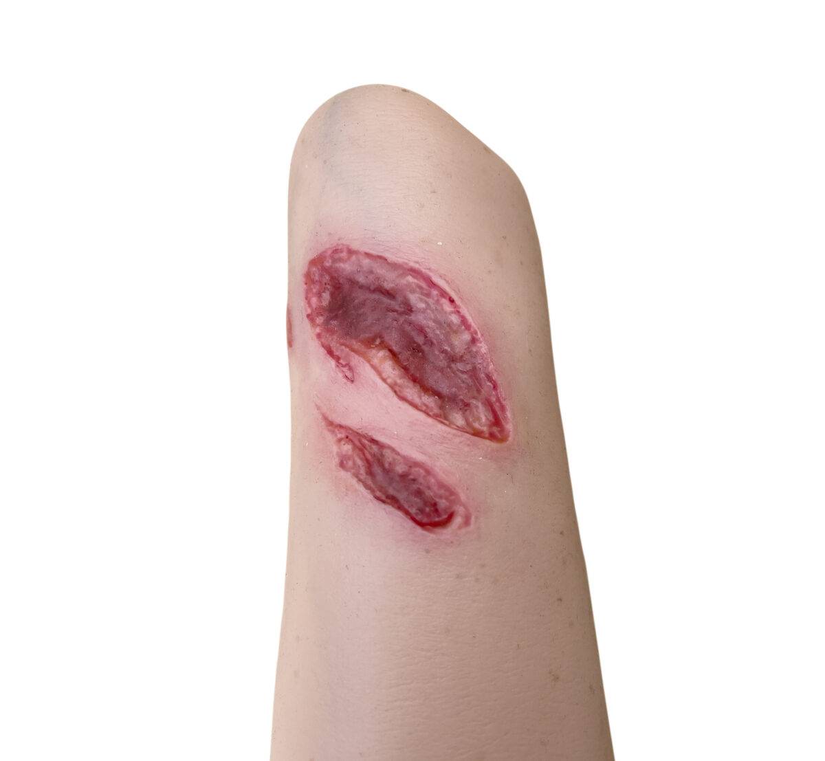 Der „Sleeve Arm mit Risswunde“ von MEDICAL FX Germany ist ein Modell zum Überstülpen, das eine detaillierte Risswunde darstellt und speziell für die Ausbildung in der Wundversorgu…