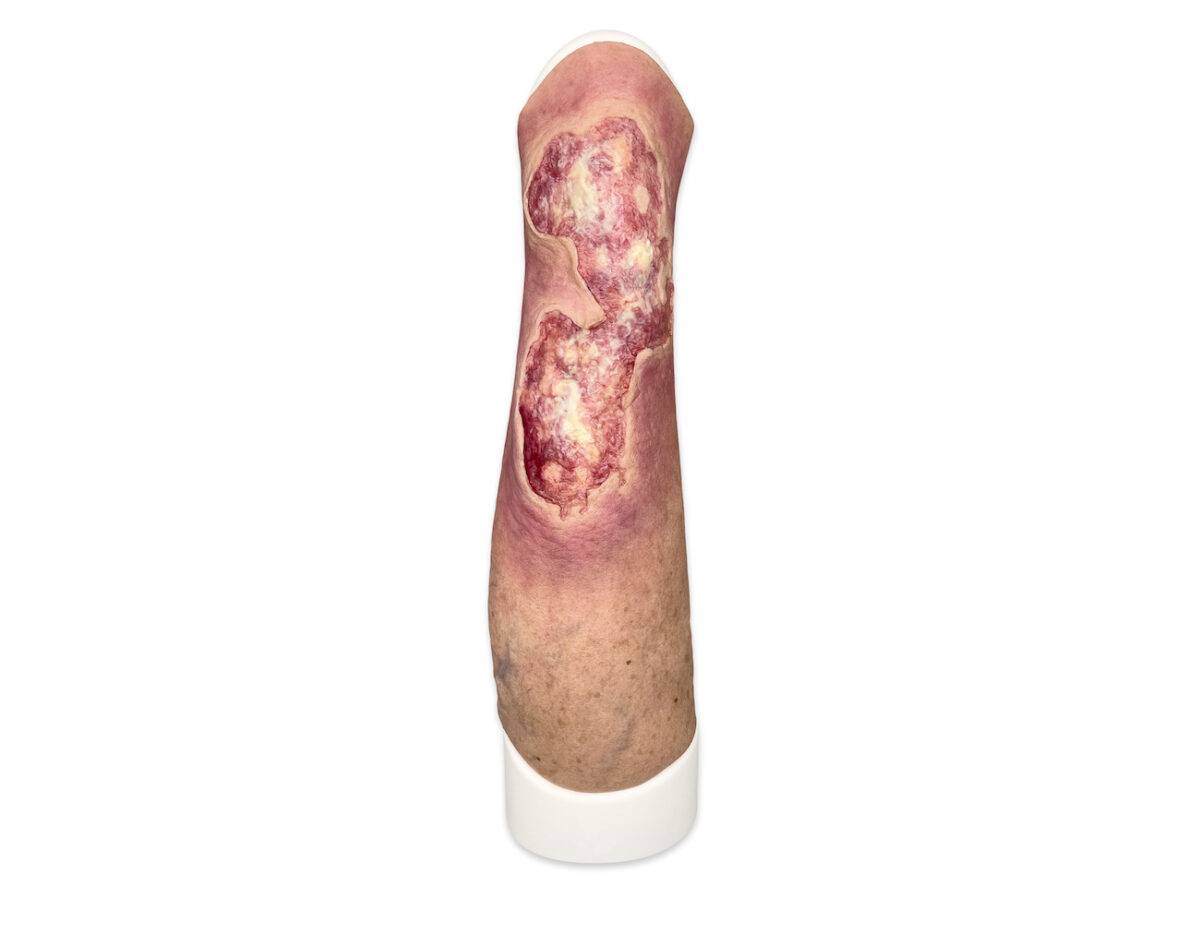 Das Wundmodell „Sleeve Bein mit Gamaschenulkus“ von MEDICAL FX Germany ist ein hochspezialisiertes Trainingswerkzeug, das für das medizinische Training zur Behandlung von venösen…
