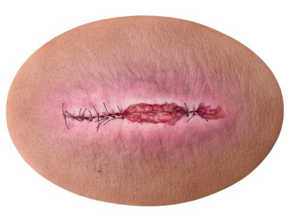 Das Silikonmodell „Stick-On Medium OP Wunde halboffen" von MEDICAL FX Germany ist die Darstellung einer halboffenen Operationswunde in mittlerer Größe, die speziell für Ausbildung…