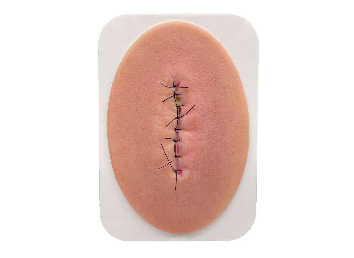 Das Modell „Stick-On Small OP-Wunde geschlossen und entzündet" von MEDICAL FX Germany bietet die präzise und realistische Darstellung einer geschlossenen, entzündeten Operationswu…