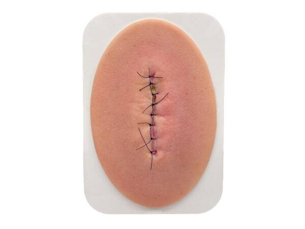 Das Modell „Stick-On Small OP-Wunde geschlossen und entzündet" von MEDICAL FX Germany bietet die präzise und realistische Darstellung einer geschlossenen, entzündeten Operationswu…