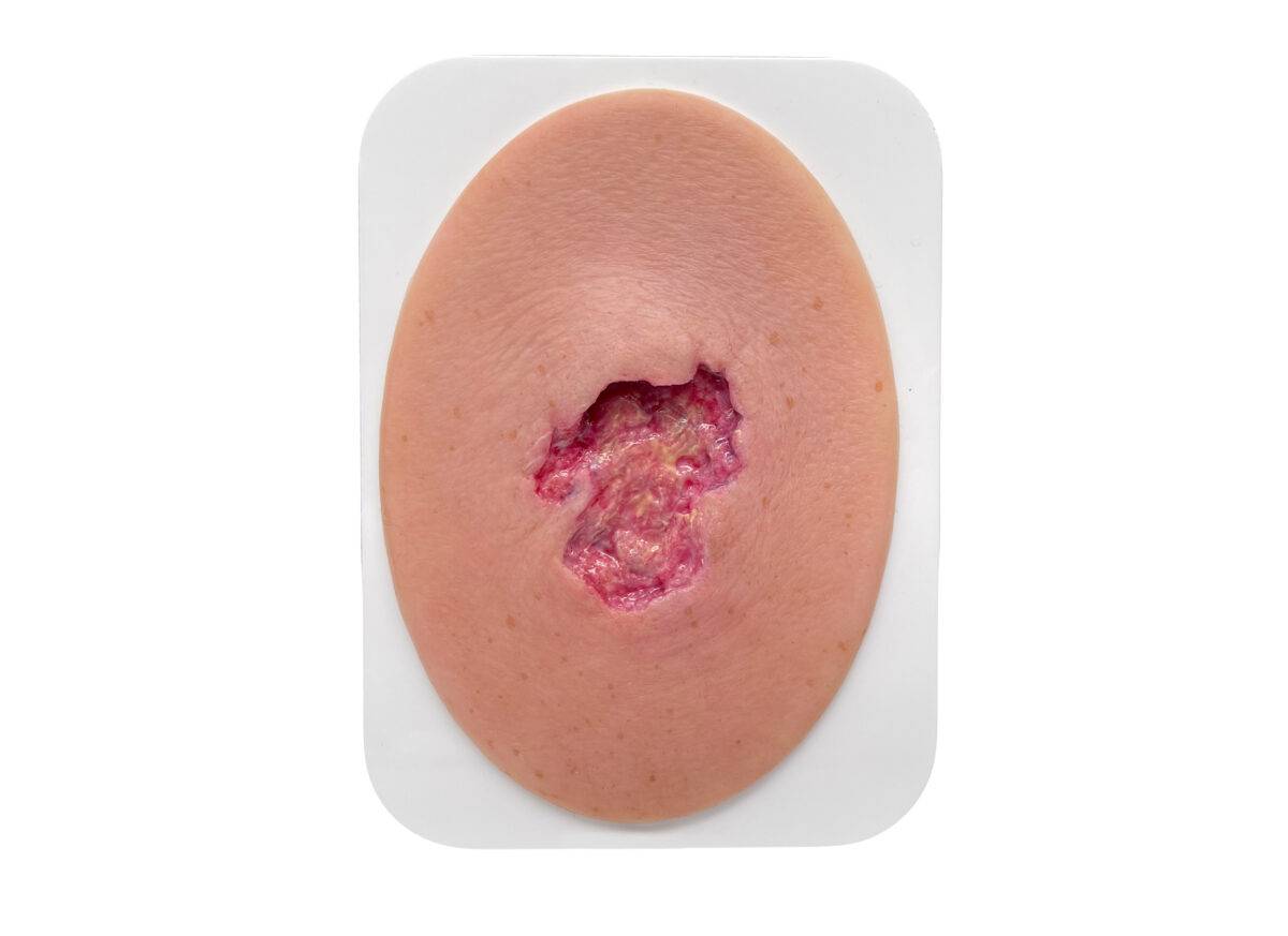 Das Modell „Stick-On Small Ulcer mit Unterminierung" von MEDICAL FX Germany ist eine Lehrressource, die speziell entwickelt wurde, um die Komplexität von Ulzera mit Unterminierung…
