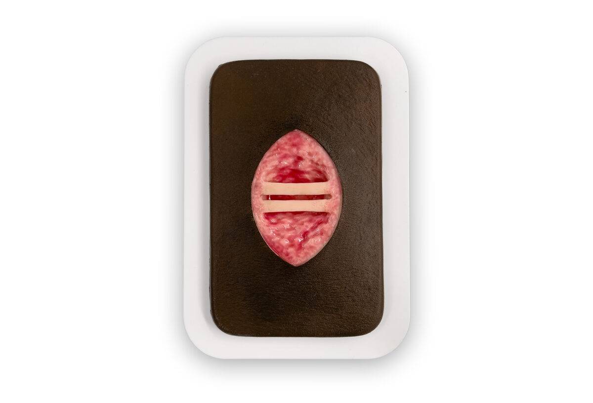 W10 04 0058 00 4 Pocketwunde Chirurgische Wunde mit offenliegenden Sehnen MEDICALFX GERMANY Kopie