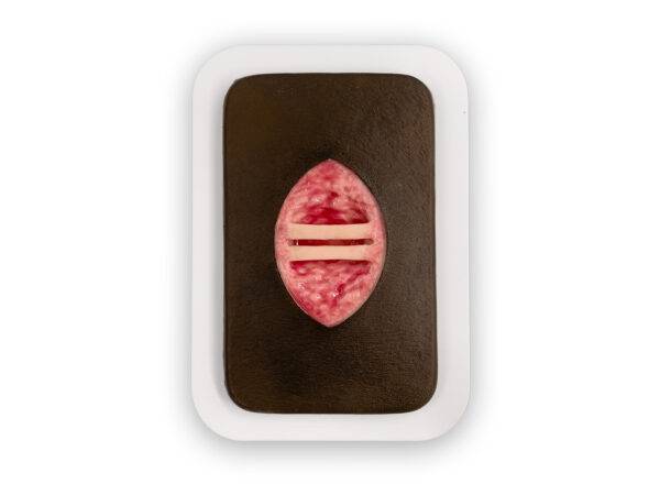 W10 04 0058 00 4 Pocketwunde Chirurgische Wunde mit offenliegenden Sehnen MEDICALFX GERMANY Kopie