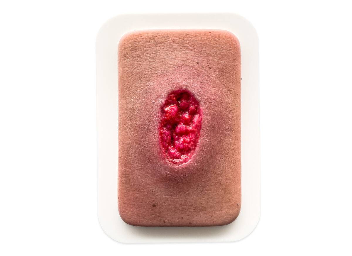 Das Modell „Pocketwunde Hypergranulation“ von MEDICAL FX Germany bietet eine detaillierte Darstellung des Zustands der Hypergranulation, einem wichtigen Aspekt im Bereich des Wund…