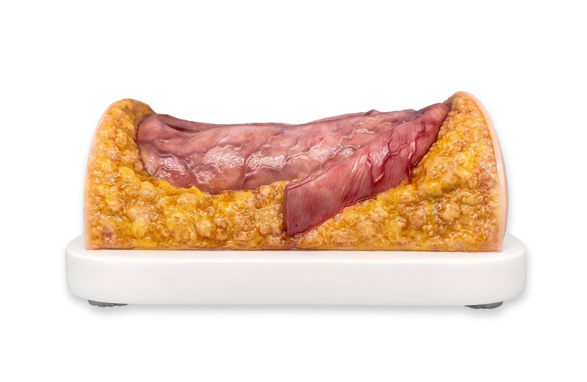 Das „Rahmenmodell Enddarm-Simulator Small" von MEDICAL FX Germany ist ein hochwertiges, realistisches Trainingsmodell, das speziell für medizinische Schulungen und Übungen entwick…