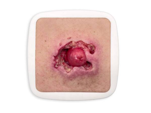 Das „Rahmenmodell Stomaausriss“ von MEDICAL FX Germany stellt einen realistischen Stomaausriss dar und eignet sich ideal für medizinische Schulungen und Simulationen. Gefertigt au…