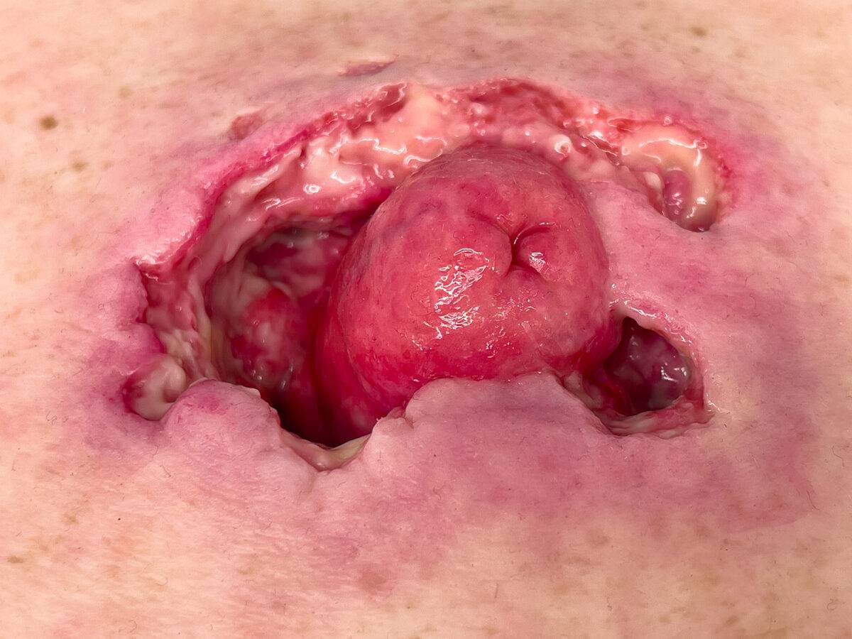 Das „Rahmenmodell Stomaausriss“ von MEDICAL FX Germany stellt einen realistischen Stomaausriss dar und eignet sich ideal für medizinische Schulungen und Simulationen. Gefertigt au…