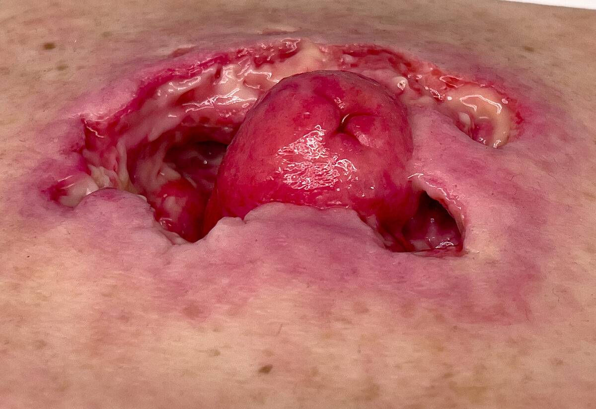 Das „Rahmenmodell Stomaausriss“ von MEDICAL FX Germany stellt einen realistischen Stomaausriss dar und eignet sich ideal für medizinische Schulungen und Simulationen. Gefertigt au…