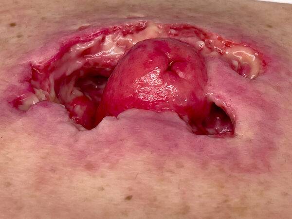 Das „Rahmenmodell Stomaausriss“ von MEDICAL FX Germany stellt einen realistischen Stomaausriss dar und eignet sich ideal für medizinische Schulungen und Simulationen. Gefertigt au…
