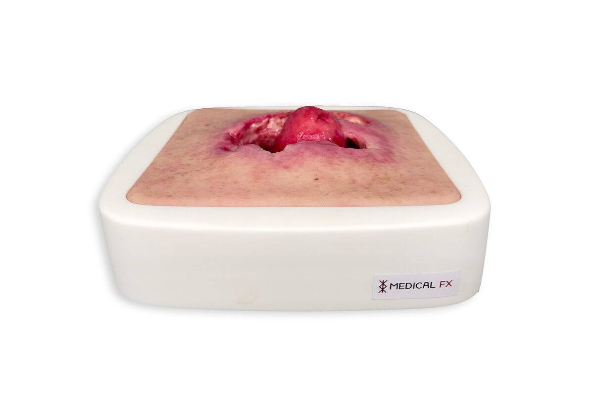 Das „Rahmenmodell Stomaausriss“ von MEDICAL FX Germany stellt einen realistischen Stomaausriss dar und eignet sich ideal für medizinische Schulungen und Simulationen. Gefertigt au…