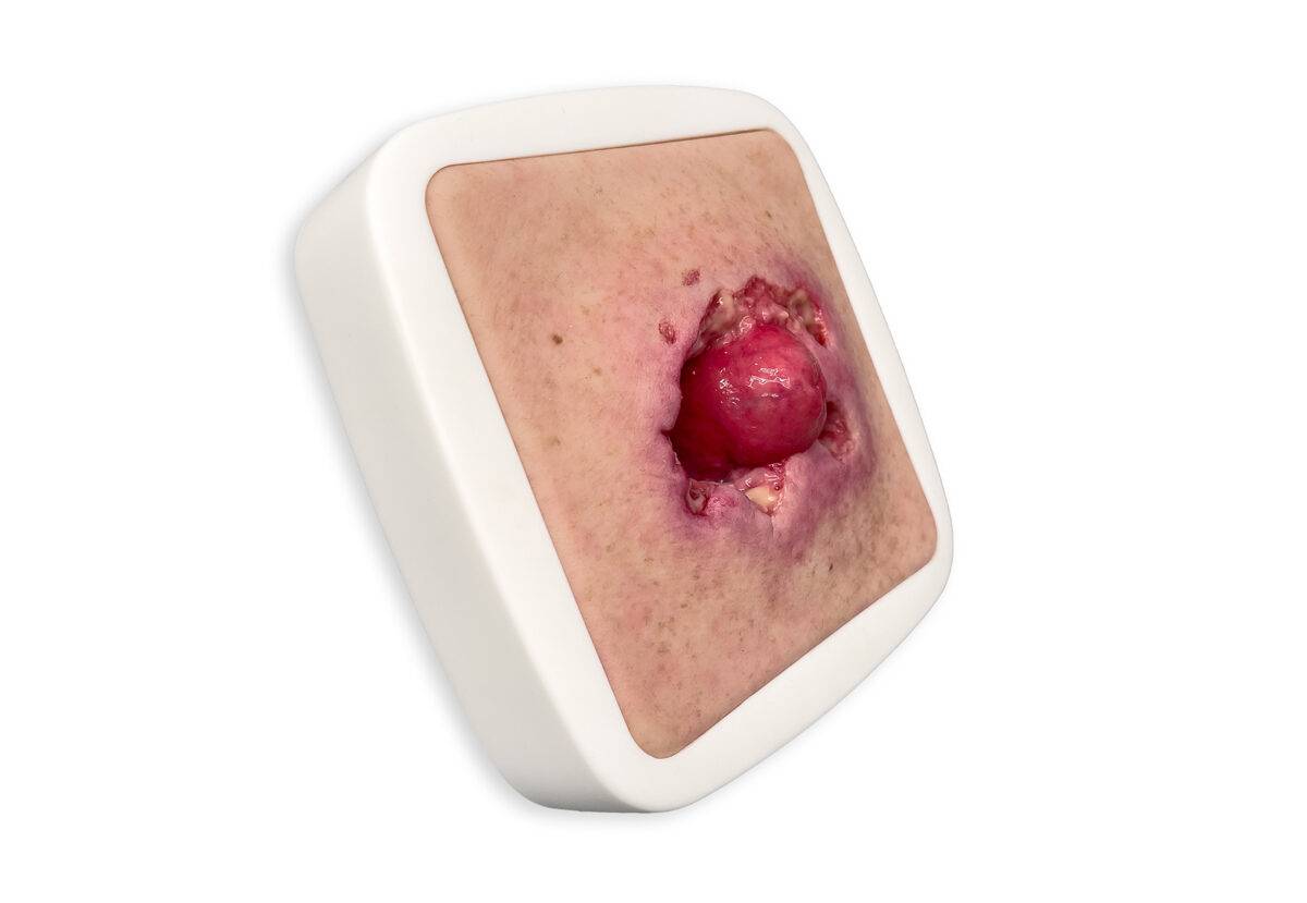 Das „Rahmenmodell Stomaausriss“ von MEDICAL FX Germany stellt einen realistischen Stomaausriss dar und eignet sich ideal für medizinische Schulungen und Simulationen. Gefertigt au…