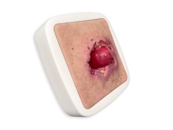 Das „Rahmenmodell Stomaausriss“ von MEDICAL FX Germany stellt einen realistischen Stomaausriss dar und eignet sich ideal für medizinische Schulungen und Simulationen. Gefertigt au…