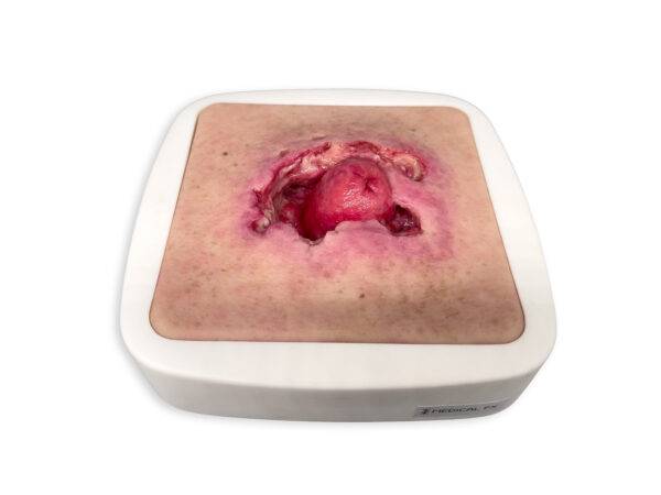 Das „Rahmenmodell Stomaausriss“ von MEDICAL FX Germany stellt einen realistischen Stomaausriss dar und eignet sich ideal für medizinische Schulungen und Simulationen. Gefertigt au…