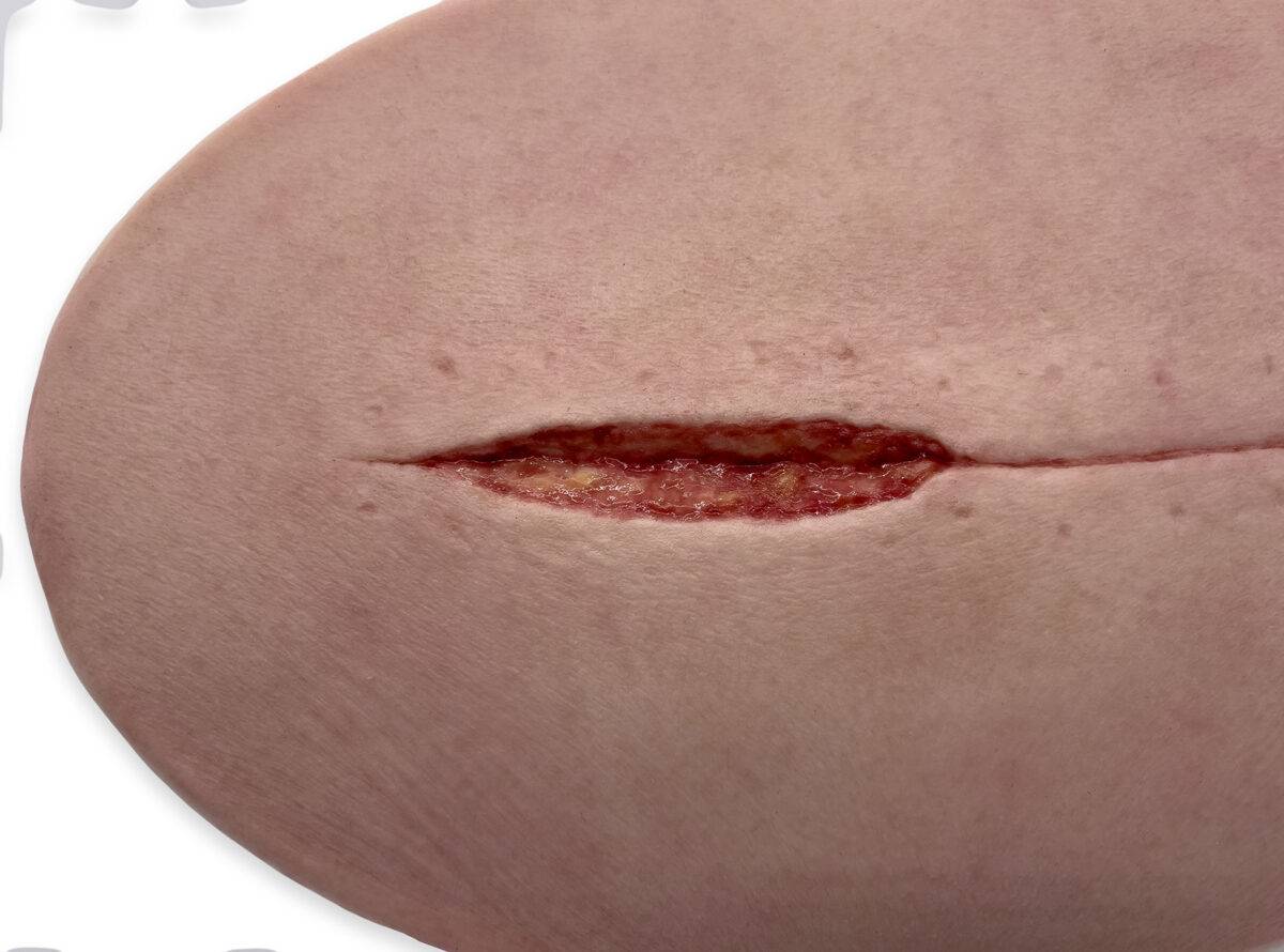 Das „Stick-On Large Kaiserschnitt“-Modell ermöglicht eine realistische Darstellung einer Kaiserschnittnarbe. Aus hochwertigem Silikon gefertigt, bietet es eine lebensechte Textur…