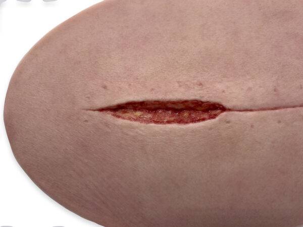 Das „Stick-On Large Kaiserschnitt“-Modell ermöglicht eine realistische Darstellung einer Kaiserschnittnarbe. Aus hochwertigem Silikon gefertigt, bietet es eine lebensechte Textur…