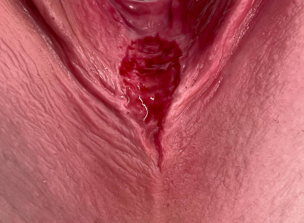 Das „Stick-On Medium Dammriss 1. Grades“-Modell von MEDICAL FX Germany ermöglicht eine realistische Darstellung eines Dammrisses 1. Grades. Aus hochwertigem Silikon gefertigt, übe…