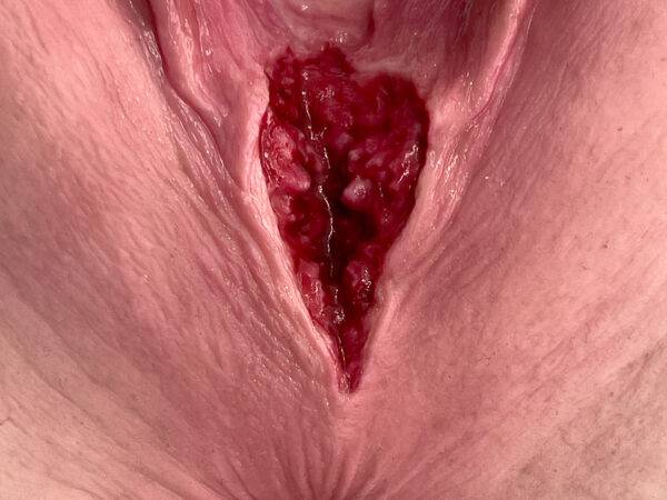 Das „Stick-On Medium Dammriss 2. Grades“-Modell von MEDICAL FX Germany bietet eine realistische Darstellung eines Dammrisses 2. Grades. Gefertigt aus hochwertigem Silikon, bestich…