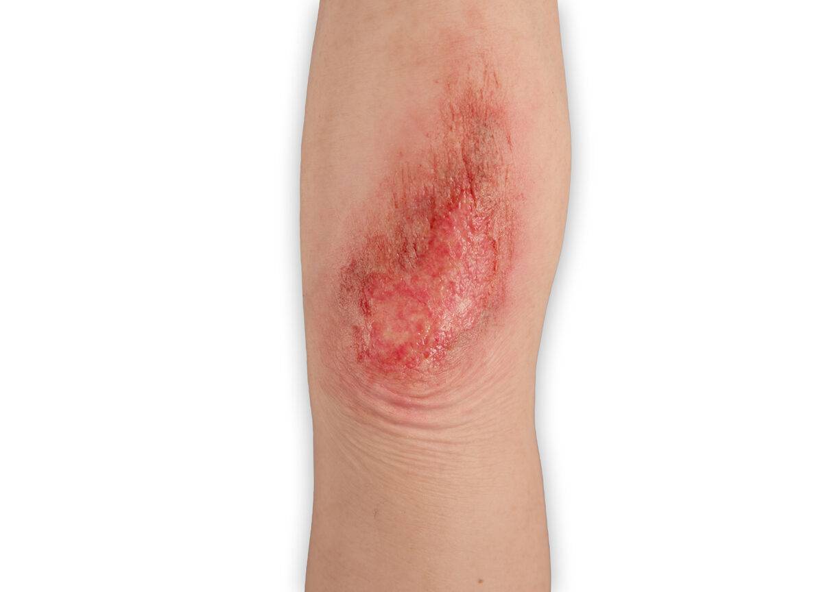 Das Modell „Sleeve Long Arm-Schürfwunde“ von MEDICAL FX Germany zeigt eine realistisch gestaltete Verletzung am Unterarm bis in den Bereich des Ellbogens. Das überziehbare Sleeve…