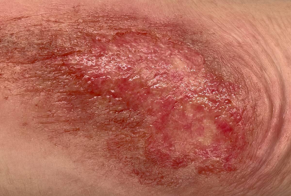 Das Modell „Sleeve Long Arm-Schürfwunde“ von MEDICAL FX Germany zeigt eine realistisch gestaltete Verletzung am Unterarm bis in den Bereich des Ellbogens. Das überziehbare Sleeve…