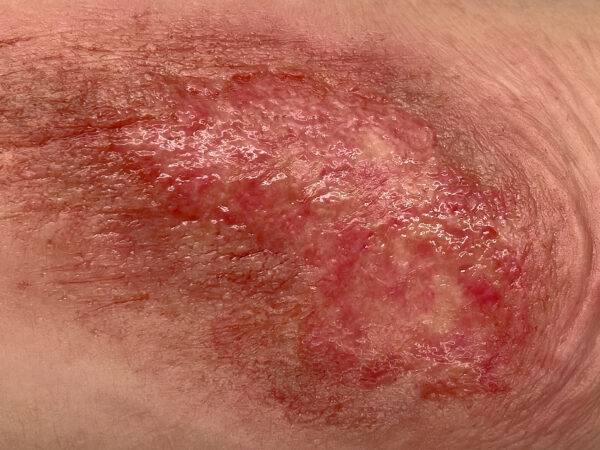 Das Modell „Sleeve Long Arm-Schürfwunde“ von MEDICAL FX Germany zeigt eine realistisch gestaltete Verletzung am Unterarm bis in den Bereich des Ellbogens. Das überziehbare Sleeve…