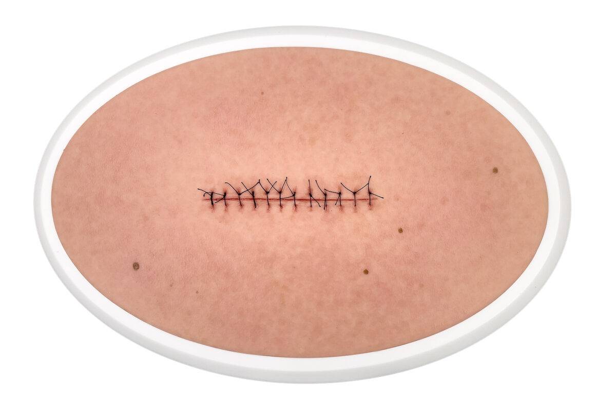 Das „Rahmenmodell Operationswunde mit Naht ohne Entzündungserscheinungen" von MEDICAL FX Germany stellt eine verschlossene Inzision ohne Entzündungszeichen realistisch dar. Es bes…