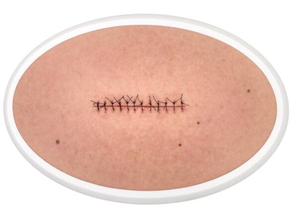 Das „Rahmenmodell Operationswunde mit Naht ohne Entzündungserscheinungen" von MEDICAL FX Germany stellt eine verschlossene Inzision ohne Entzündungszeichen realistisch dar. Es bes…