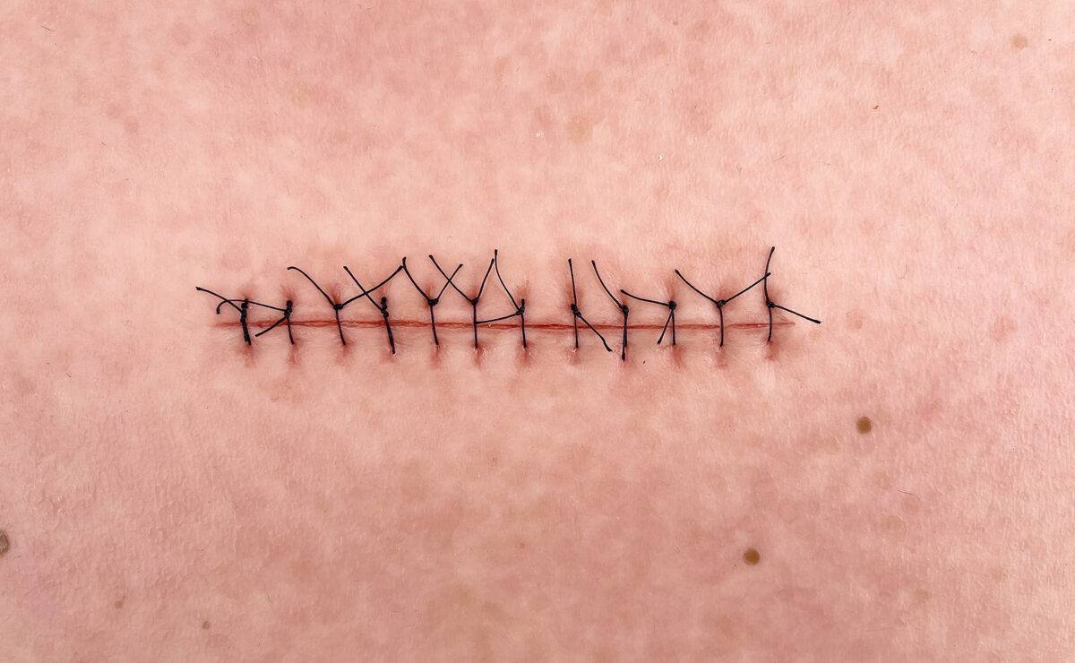 Das „Rahmenmodell Operationswunde mit Naht ohne Entzündungserscheinungen" von MEDICAL FX Germany stellt eine verschlossene Inzision ohne Entzündungszeichen realistisch dar. Es bes…