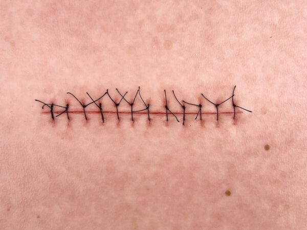 Das „Rahmenmodell Operationswunde mit Naht ohne Entzündungserscheinungen" von MEDICAL FX Germany stellt eine verschlossene Inzision ohne Entzündungszeichen realistisch dar. Es bes…