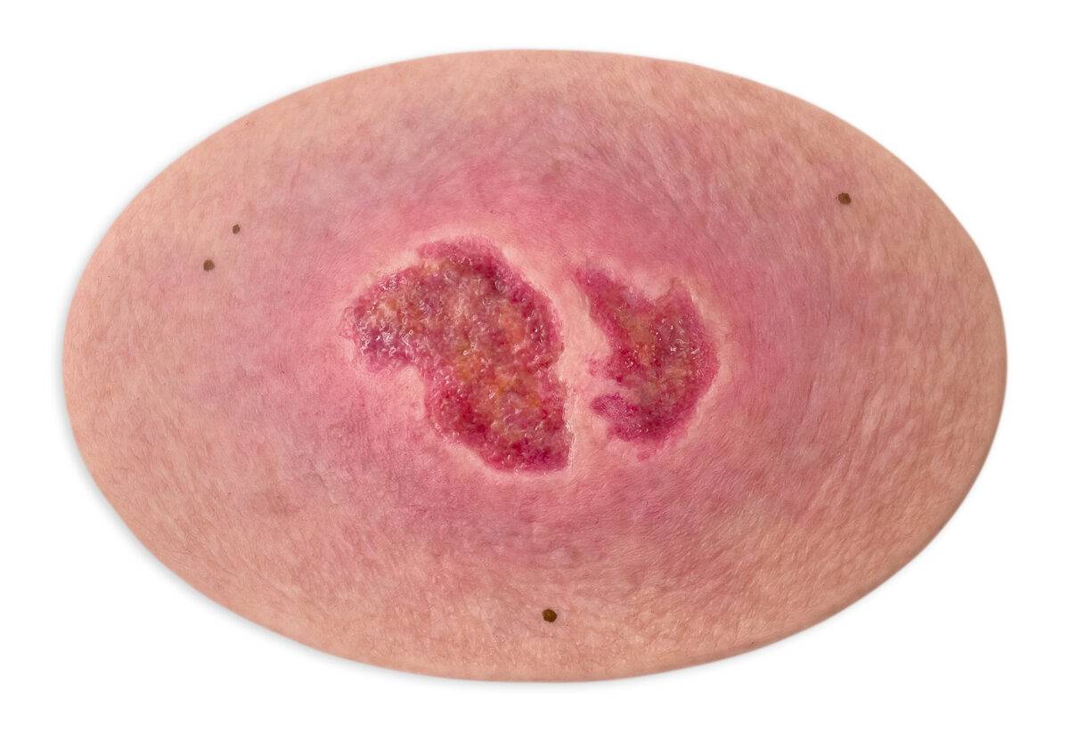 Das „Stick-On Medium Dekubitus Grad 2“-Modell von MEDICAL FX Germany ermöglicht eine realistische Darstellung eines Dekubitus im zweiten Stadium. Gefertigt aus hochwertigem Siliko…