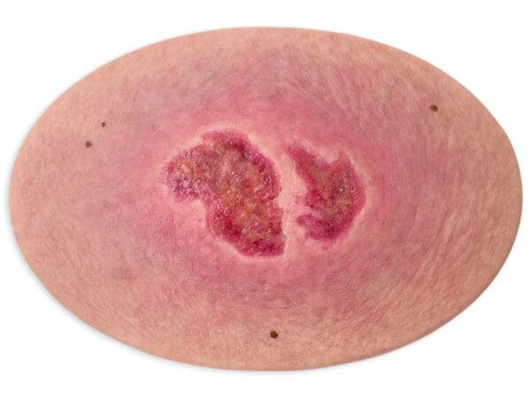 Das „Stick-On Medium Dekubitus Grad 2“-Modell von MEDICAL FX Germany ermöglicht eine realistische Darstellung eines Dekubitus im zweiten Stadium. Gefertigt aus hochwertigem Siliko…