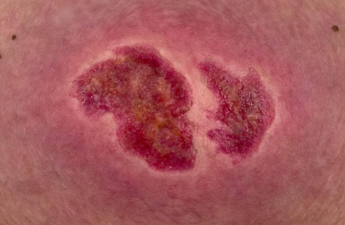 Das „Stick-On Medium Dekubitus Grad 2“-Modell von MEDICAL FX Germany ermöglicht eine realistische Darstellung eines Dekubitus im zweiten Stadium. Gefertigt aus hochwertigem Siliko…