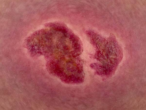 Das „Stick-On Medium Dekubitus Grad 2“-Modell von MEDICAL FX Germany ermöglicht eine realistische Darstellung eines Dekubitus im zweiten Stadium. Gefertigt aus hochwertigem Siliko…