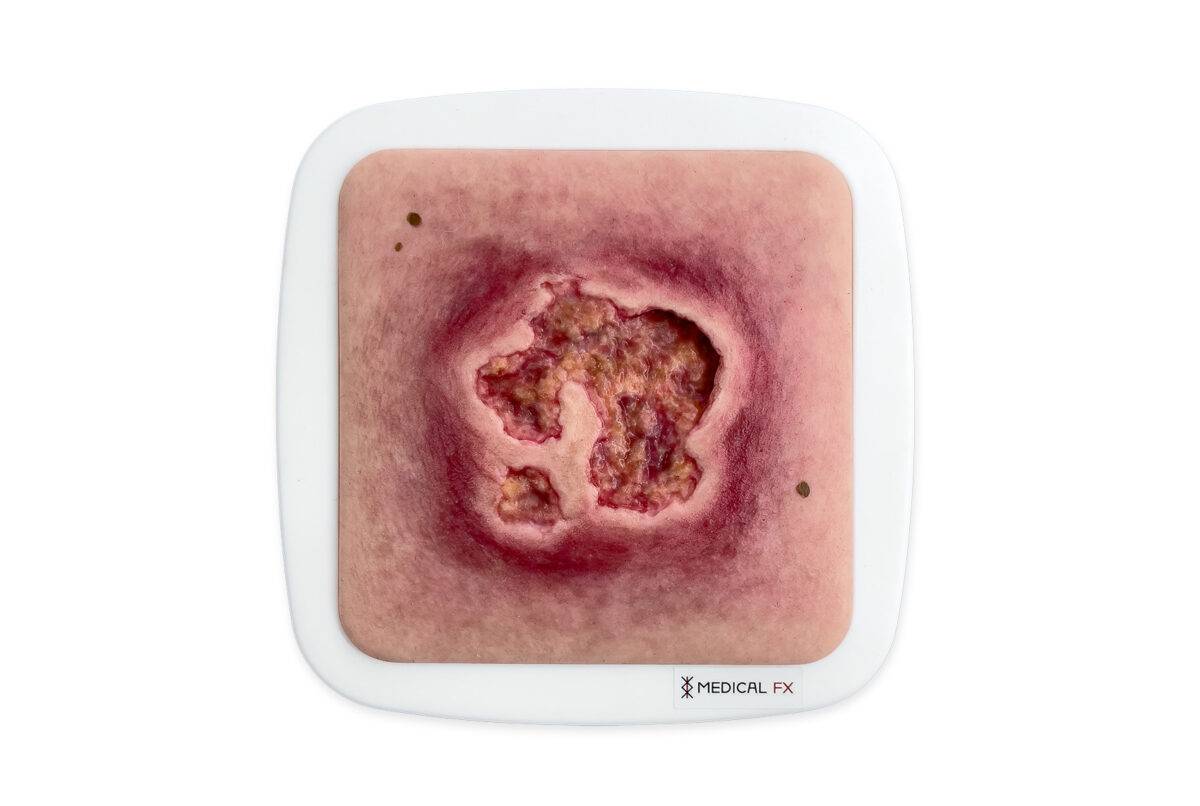 Das „Rahmenmodell Ulcer mit Unterminierung" von MEDICAL FX Germany ist ein präzise gefertigtes Lehrmodell, das speziell dafür entworfen wurde, die komplexe Struktur eines Ulcus mi…