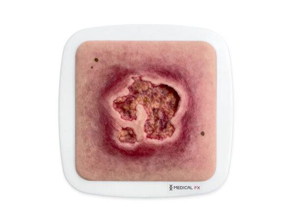 Das „Rahmenmodell Ulcer mit Unterminierung" von MEDICAL FX Germany ist ein präzise gefertigtes Lehrmodell, das speziell dafür entworfen wurde, die komplexe Struktur eines Ulcus mi…