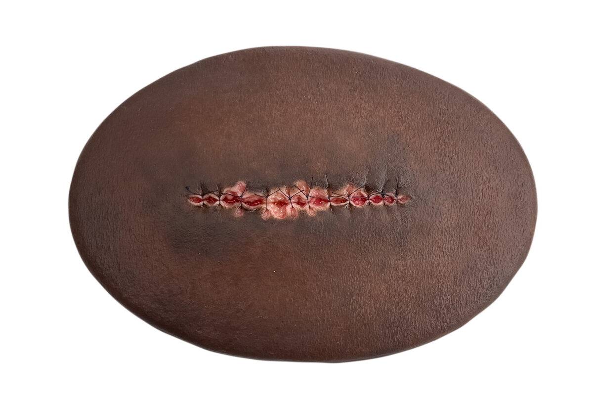 Das Wundmodell „Stick-On Medium Operationswunde mit entzündeter Nahtdehiszenz“ von MEDICAL FX Germany ist ein hochrealistisches Silikonmodell zur Darstellung einer entzündeten pos…